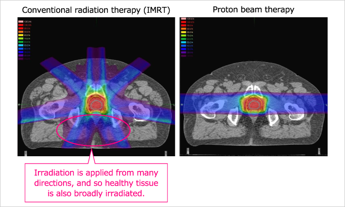 Visualizations of radiotherapies