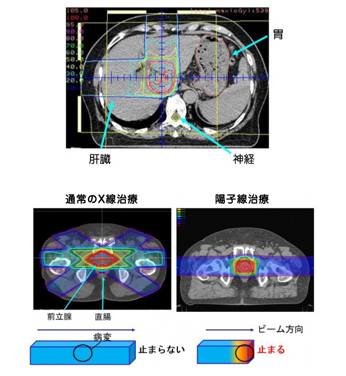 放射線治療イメージ